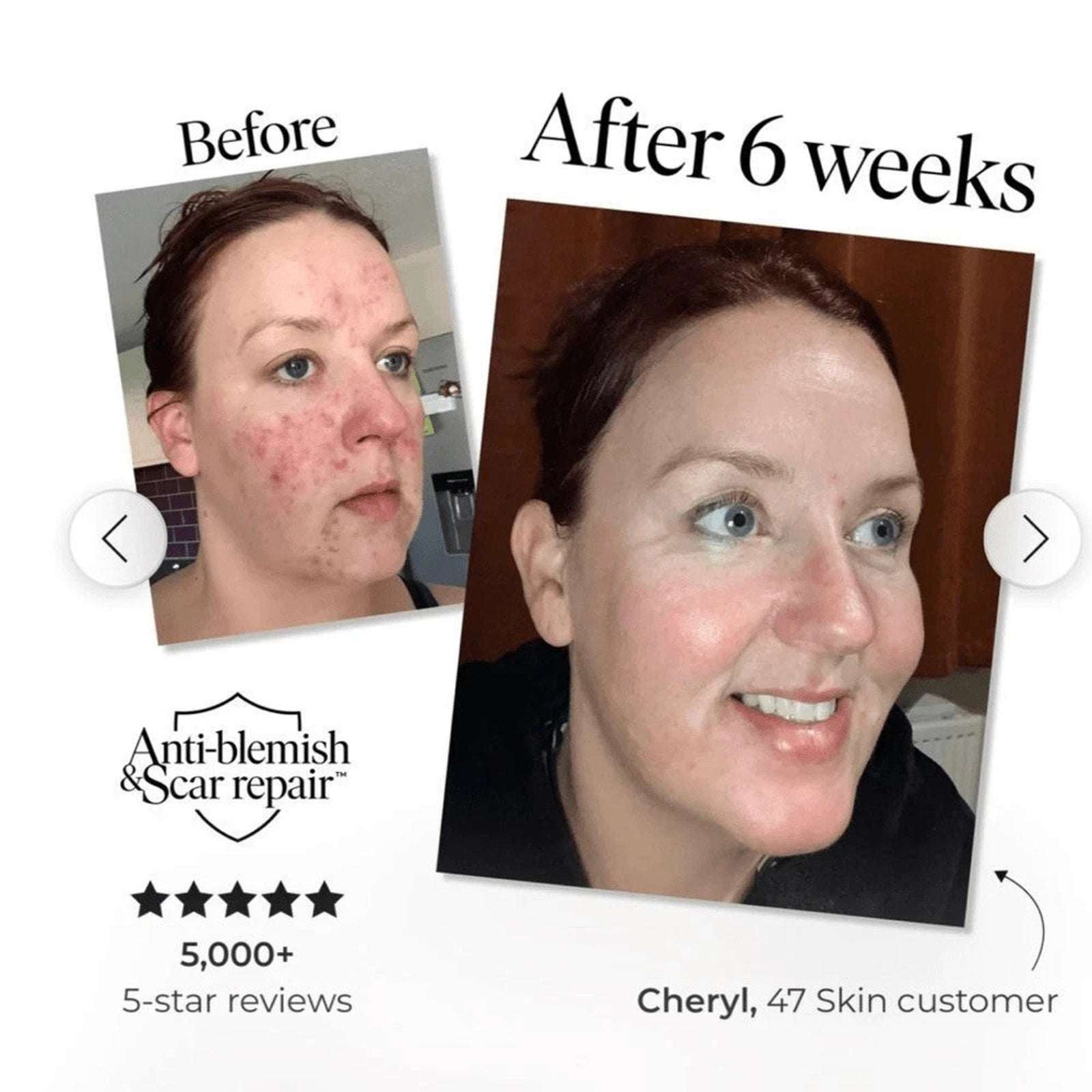 47 Skin Silver Mask, Anti-Blemish and Scar Repair w/ Silver Chitoderm, 2 fl oz.