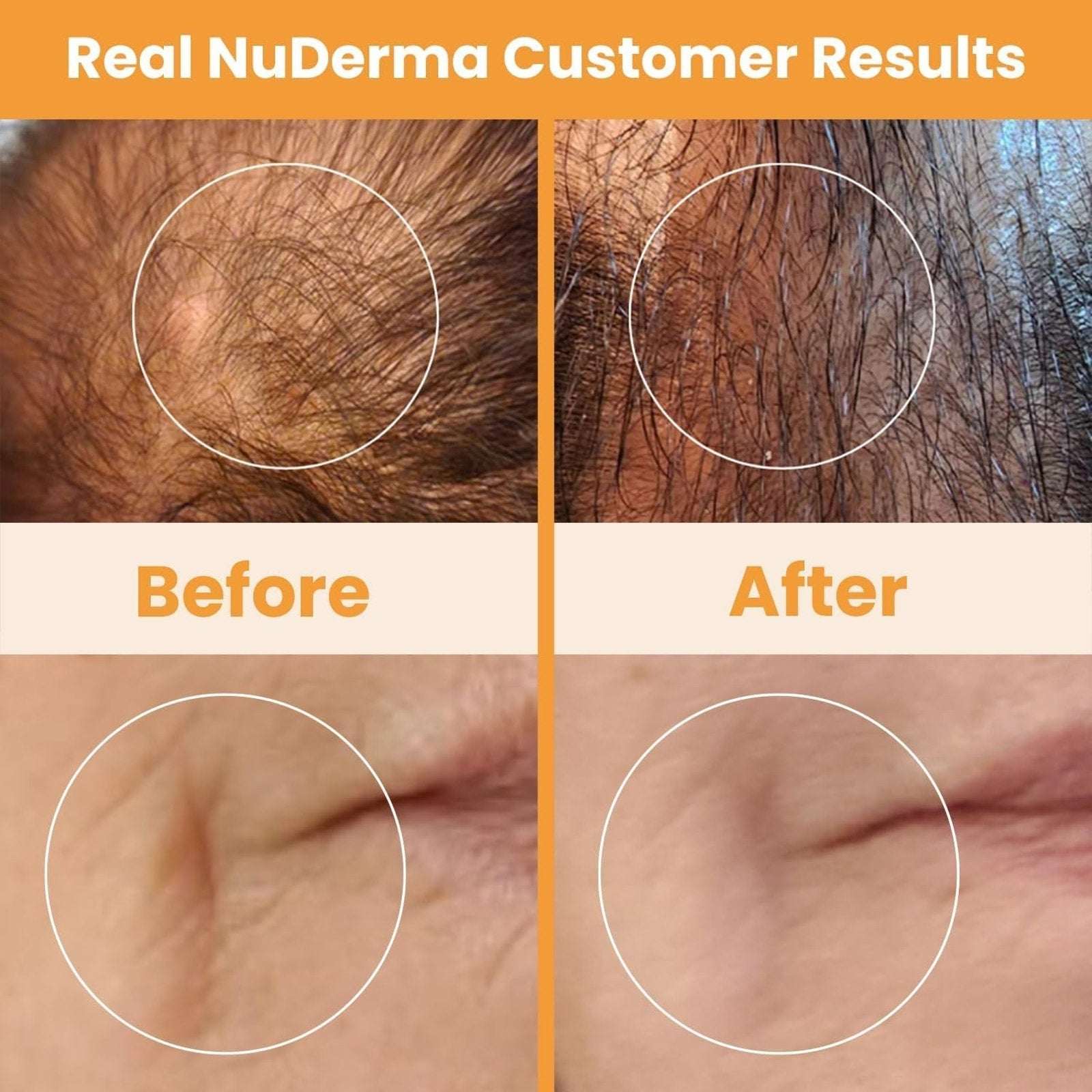 Pure Nuderma Daily Care Skin Therapy Machine with 4 Neon Wands for Skin & Hair