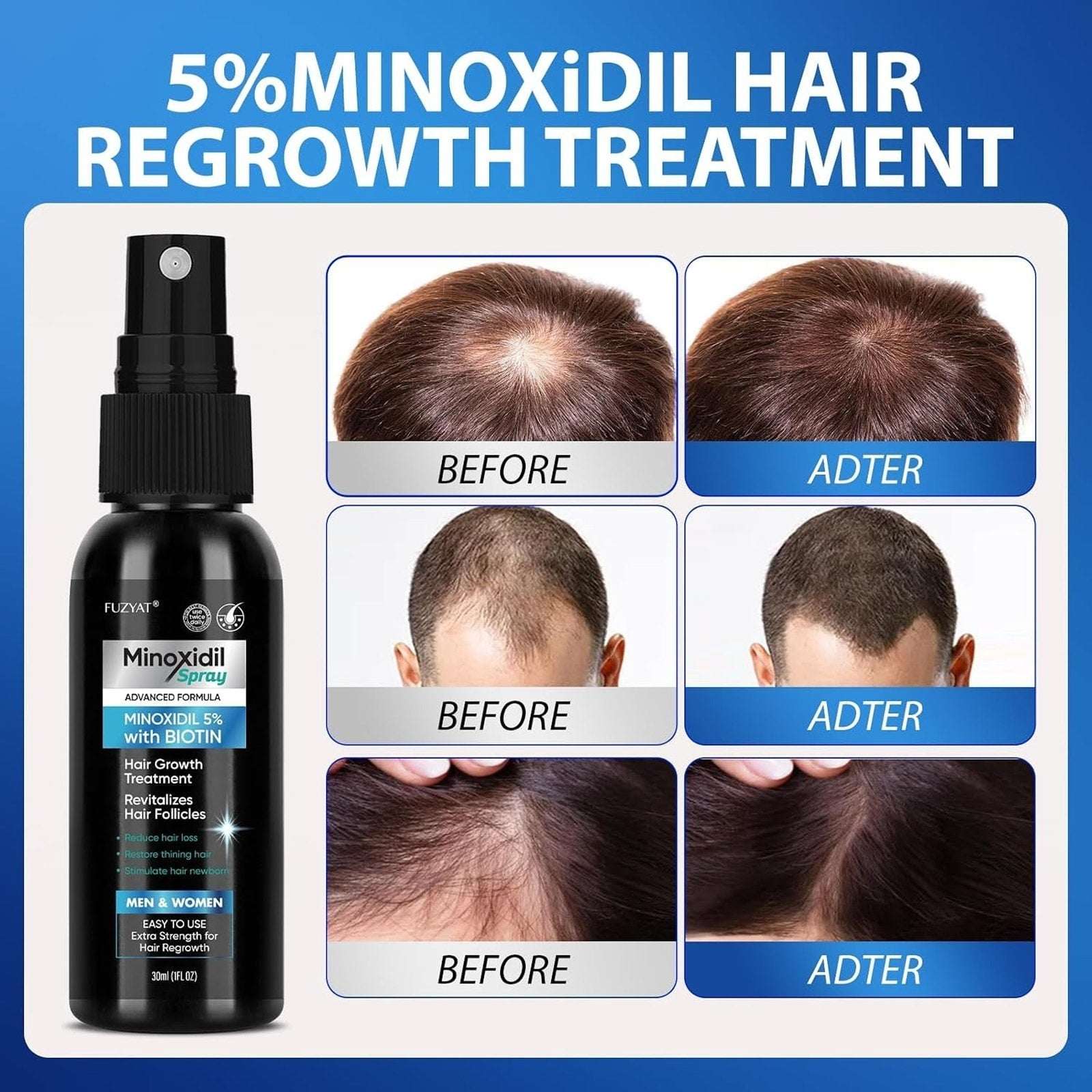 Minoxidil 5% +BIOTIN Advanced Formula Hair Regrowth Treatment 2 x 30ml/1 fl oz