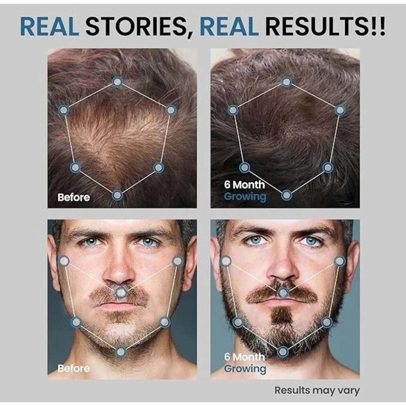 5% Minoxidil +Biotin Extra Strength Hair & Beard Regrowth Treatment 2 x 2 fl oz
