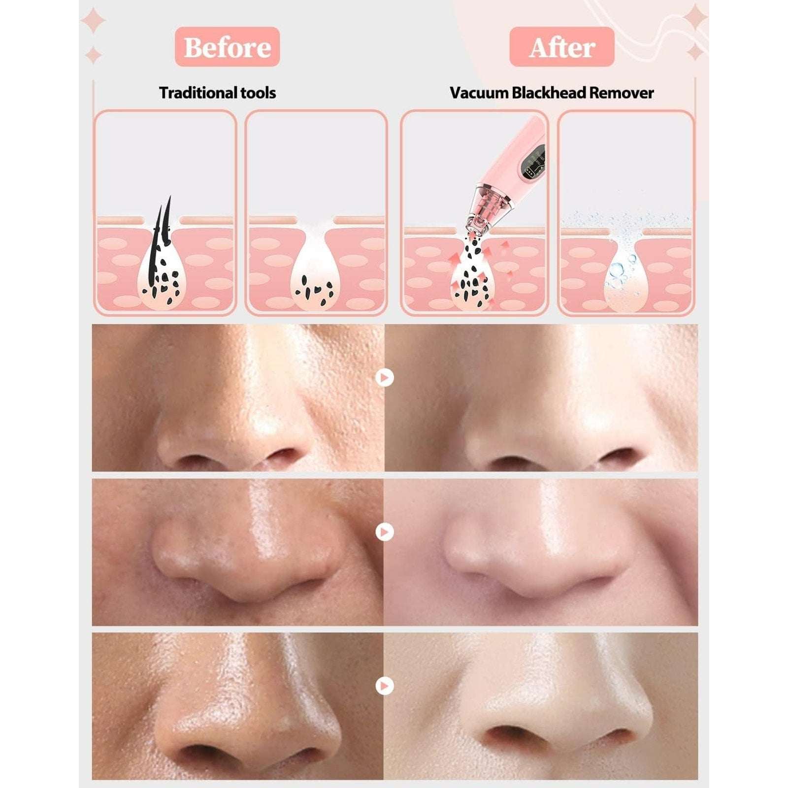 Blackhead Remover Pore Vacuum w/ LED Screen & 4 Probes Tighten, Lift & Exfoliate